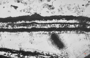 M,66y. | follicular cyst with hyaline Rushton bodies